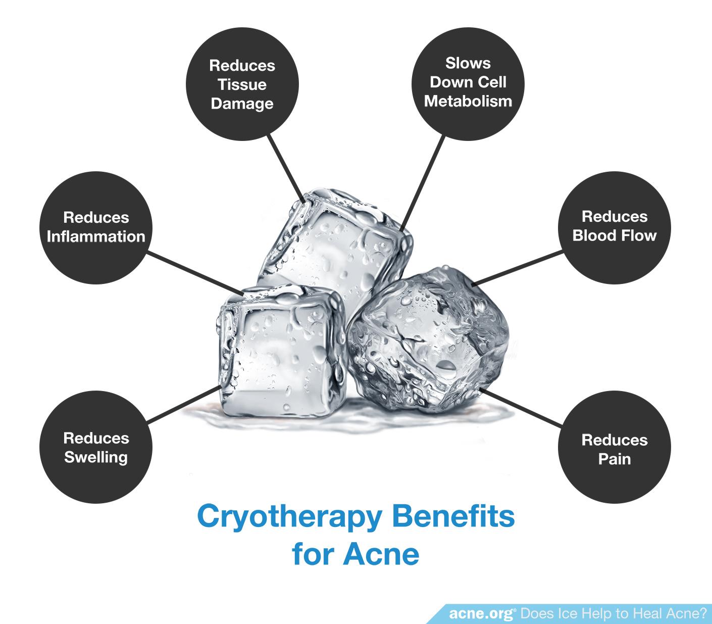 Cryotherapy Benefits for Acne