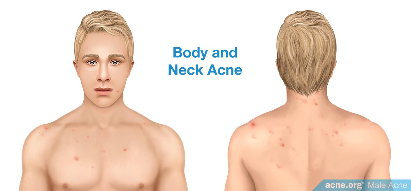 Body and Neck Acne