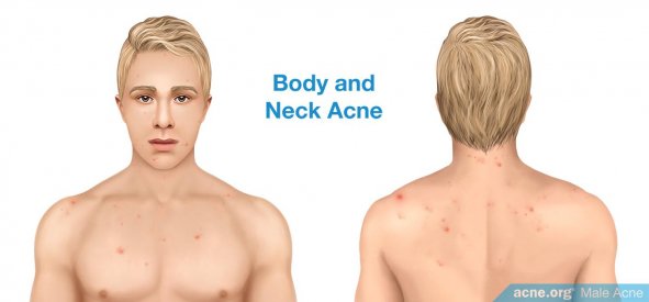 Body and Neck Acne