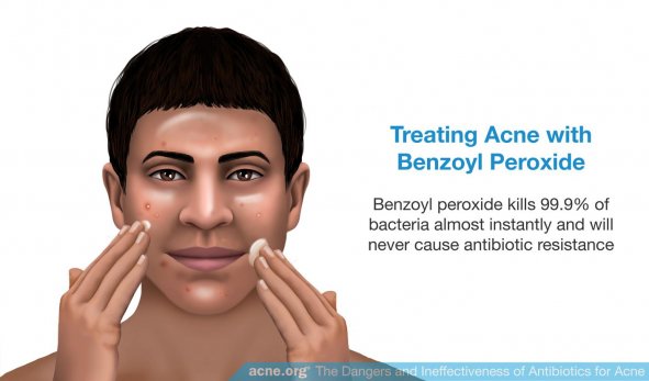 Treating Acne with Benzoyl Peroxide