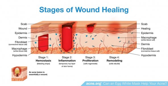 Stages of Wound Healing