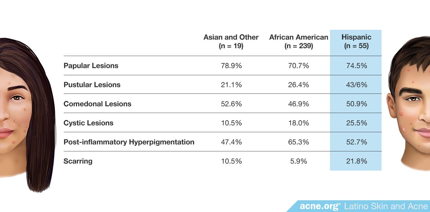 Types of Acne by Ethnicity