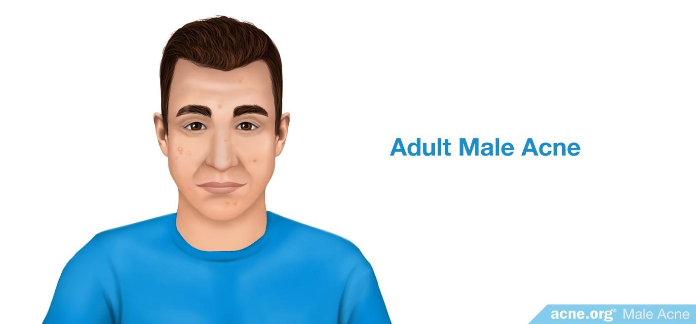 Adult Male Acne