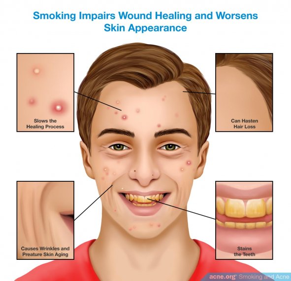 Smoking Impairs Wound Healing and Worsens Skin Appearance