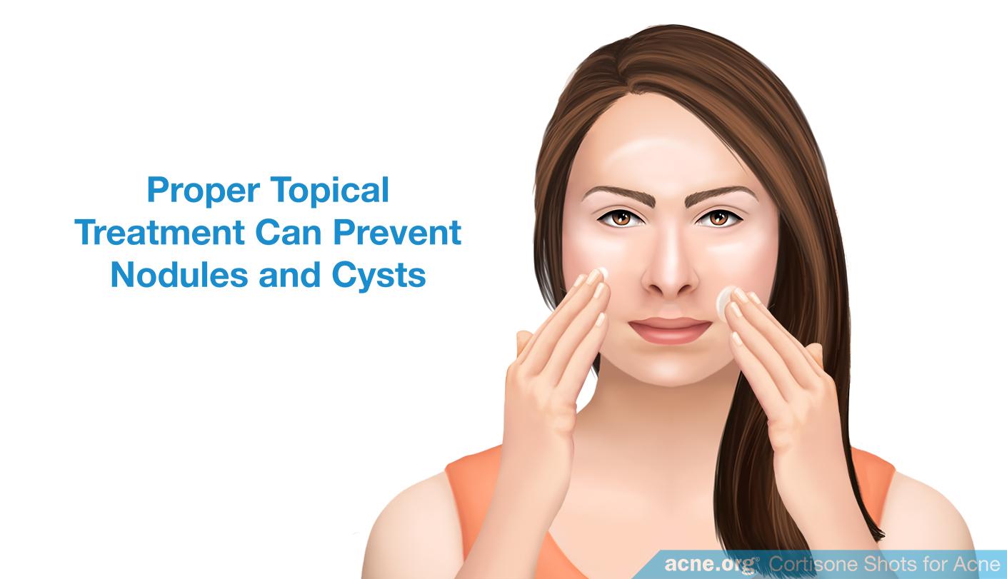 Proper Topical Treatment Can Prevent Nodules and Cysts