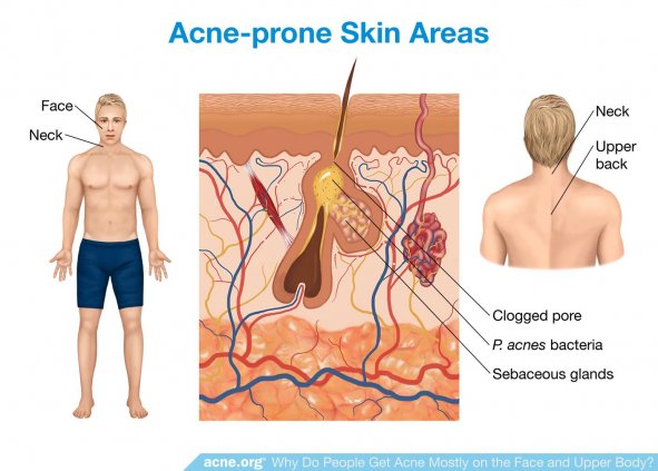 Acne-prone Skin Areas