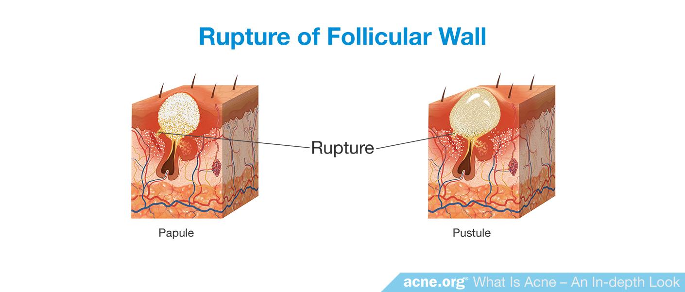 Rupture of Follicular Wall