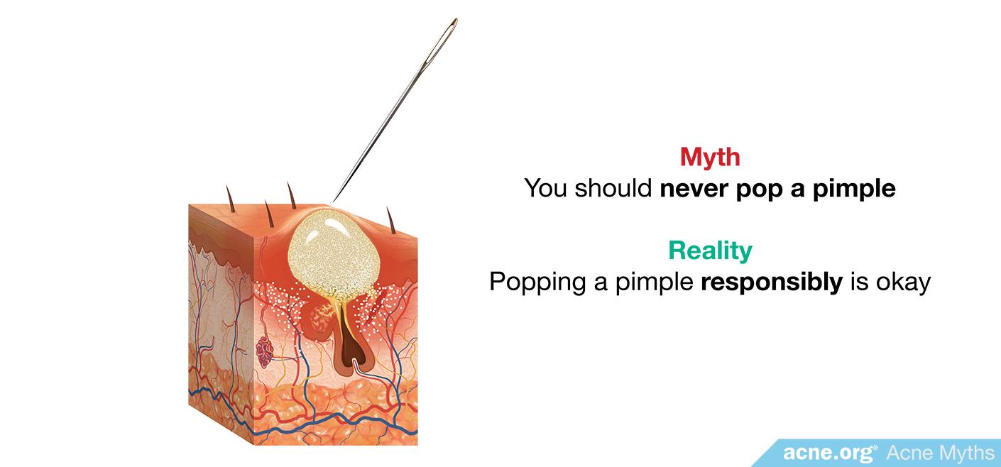 Myth: you should never pop a pimple