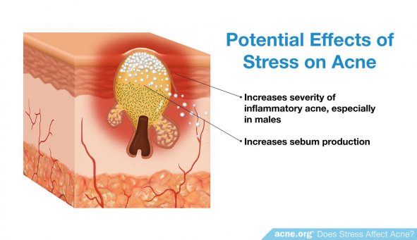 Potential Effects of Stress on Acne