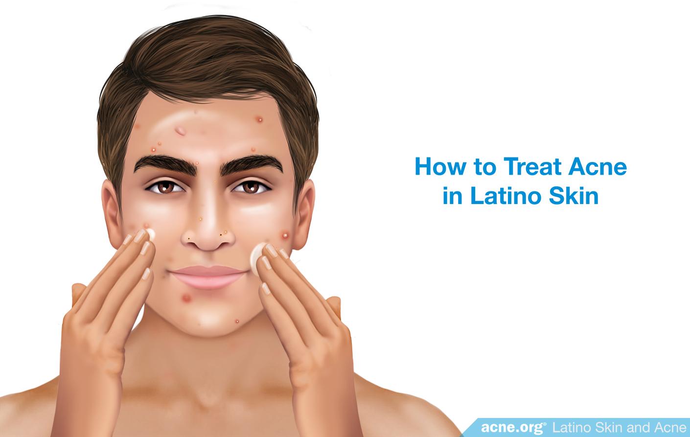 How to Treat Acne in Latino Skin