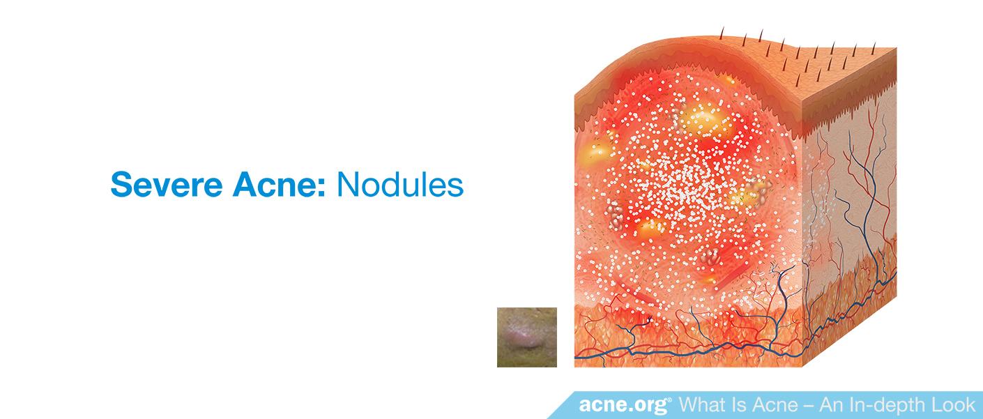 Severe Acne: Nodules