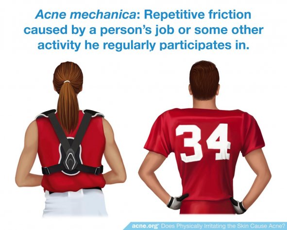 Acne Mechanica
