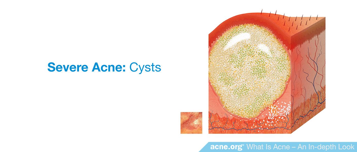 Severe Acne: Cysts