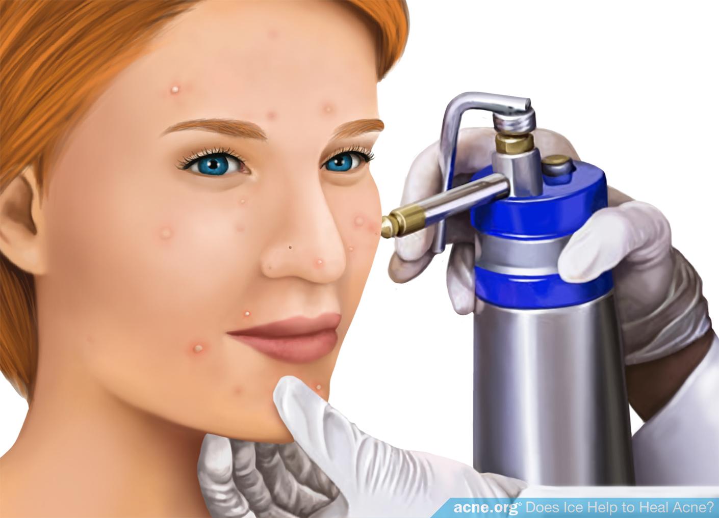 Woman Receiving Cryotherapy Treatment for Acne