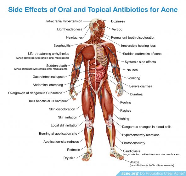 Side Effects of Oral and Topical Antibiotics for Acne