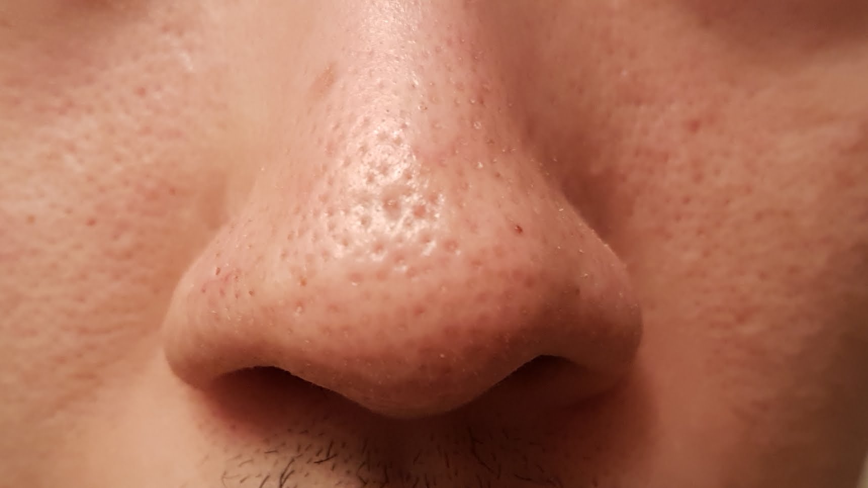 Scarred Pores On Nose Joining Together At A Loss Scar Treatments