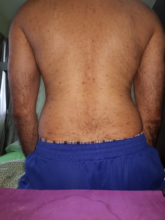 red-brown-marks-bacne-help-back-body-neck-acne-acne-forum