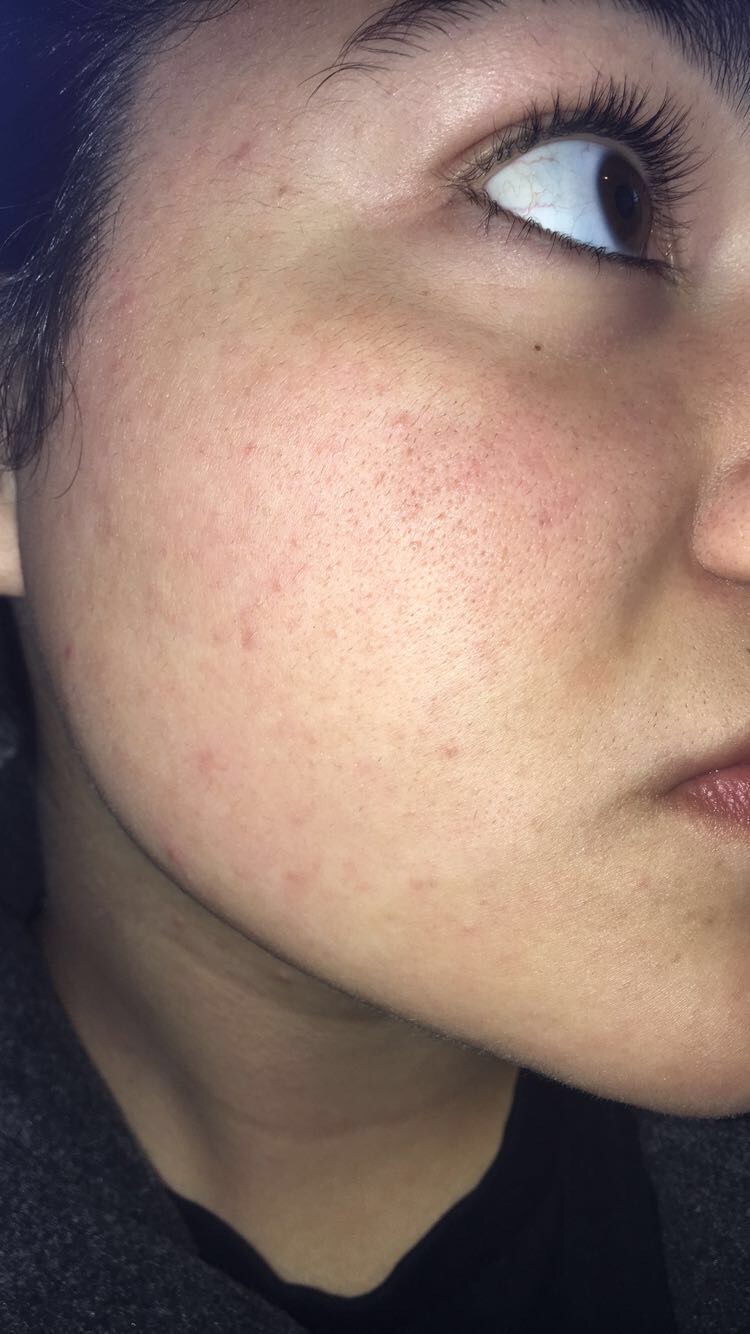 Closed comedowns / clogged pores - General acne discussion - Acne.org