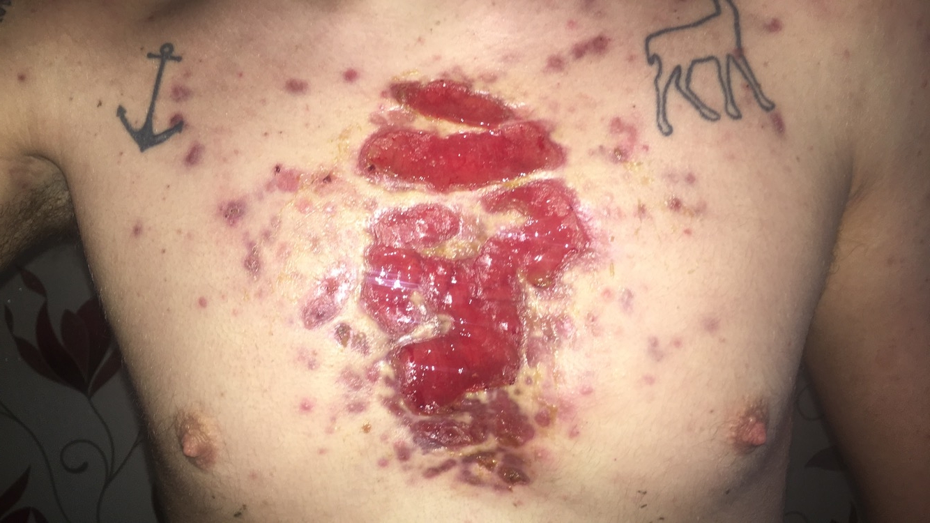 Living in hell - HUGE acne wound on chest - Back/Body/Neck acne - by