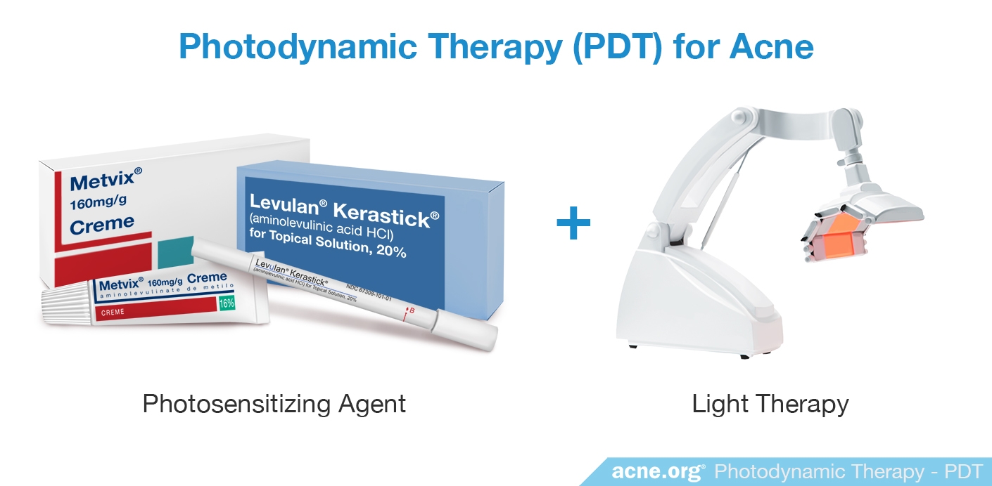 Photodynamic Therapy (PDT) for Acne - Acne.org