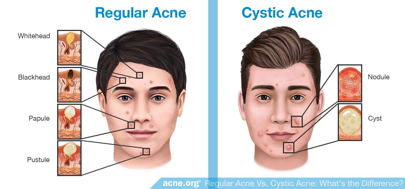 regular acne vs cystic acne what s the difference acne org regular acne vs cystic acne what s the difference acne org