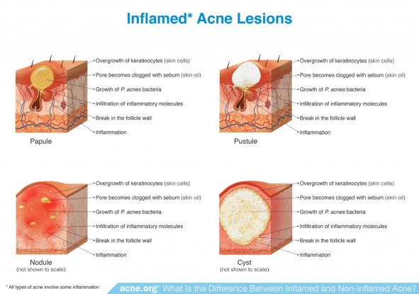 Inflamed Acne Lesions