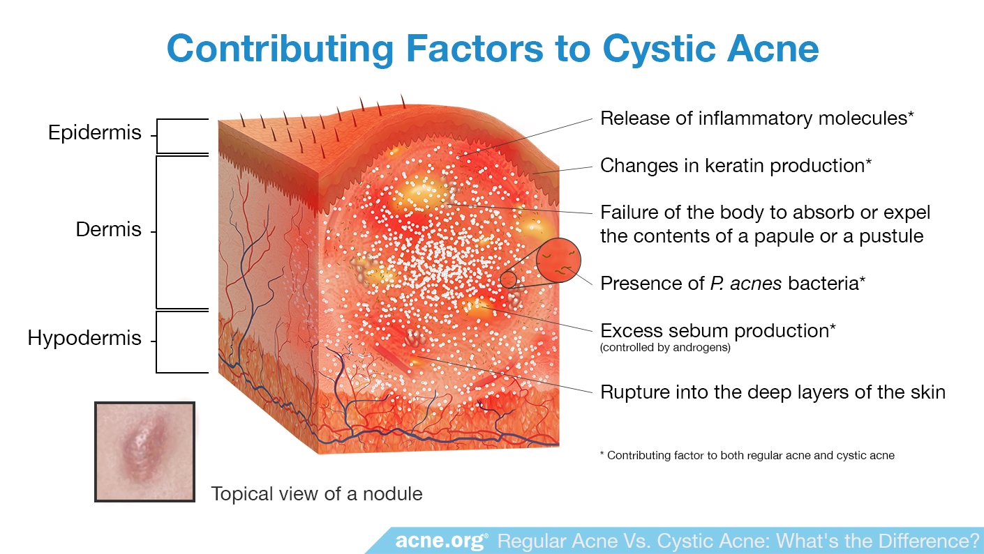 Regular Acne Vs. Cystic Acne What's the Difference?