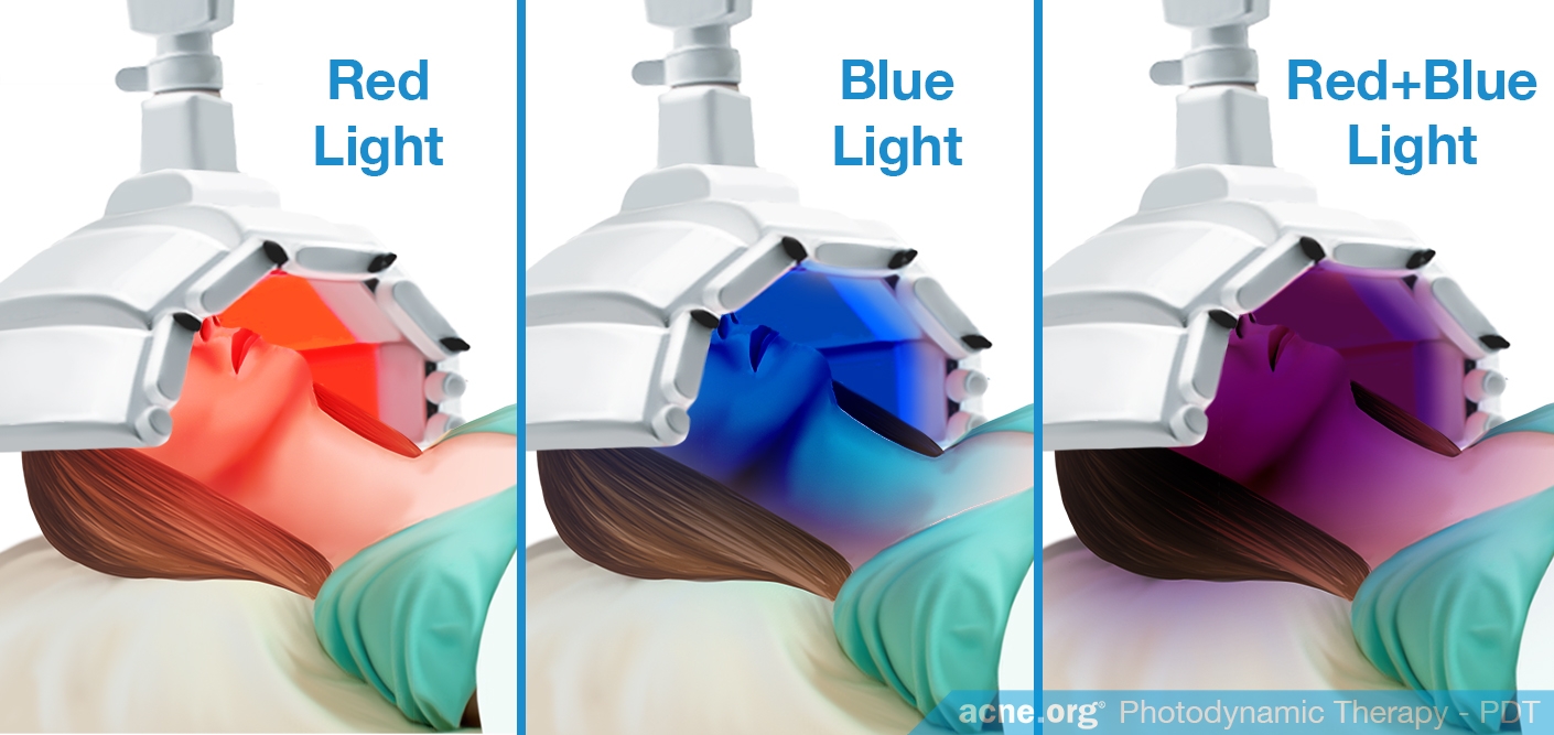 Red Light - Blue Light - Combination - Acne.org
