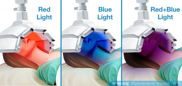 Red Light - Blue Light - Combination - Acne.org