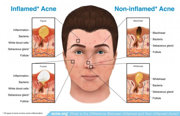 Inflamed Acne vs. Non-inflamed Acne