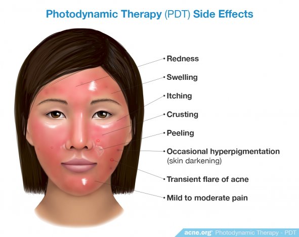 Photodynamic Therapy (PDT) Side Effects - Acne.org