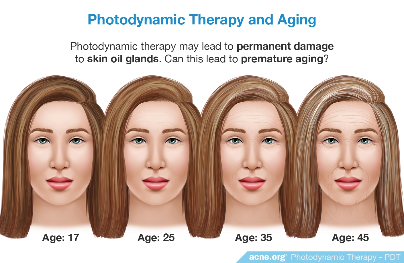 Photodynamic Therapy and Aging - Acne.org