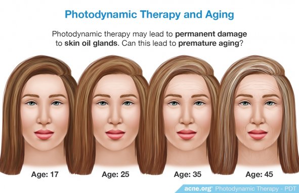 Photodynamic Therapy and Aging - Acne.org