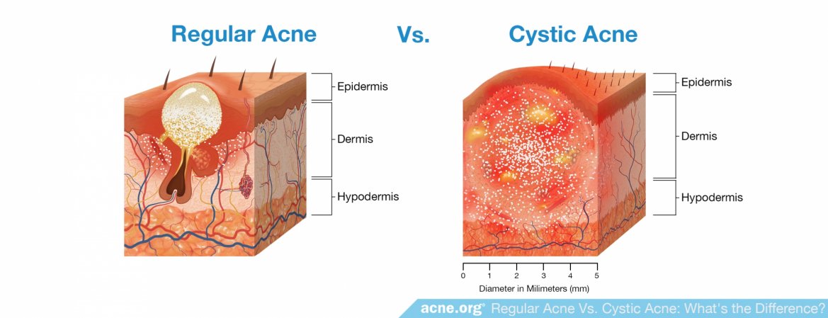 regular-acne-vs-cystic-acne-what-s-the-difference-acne