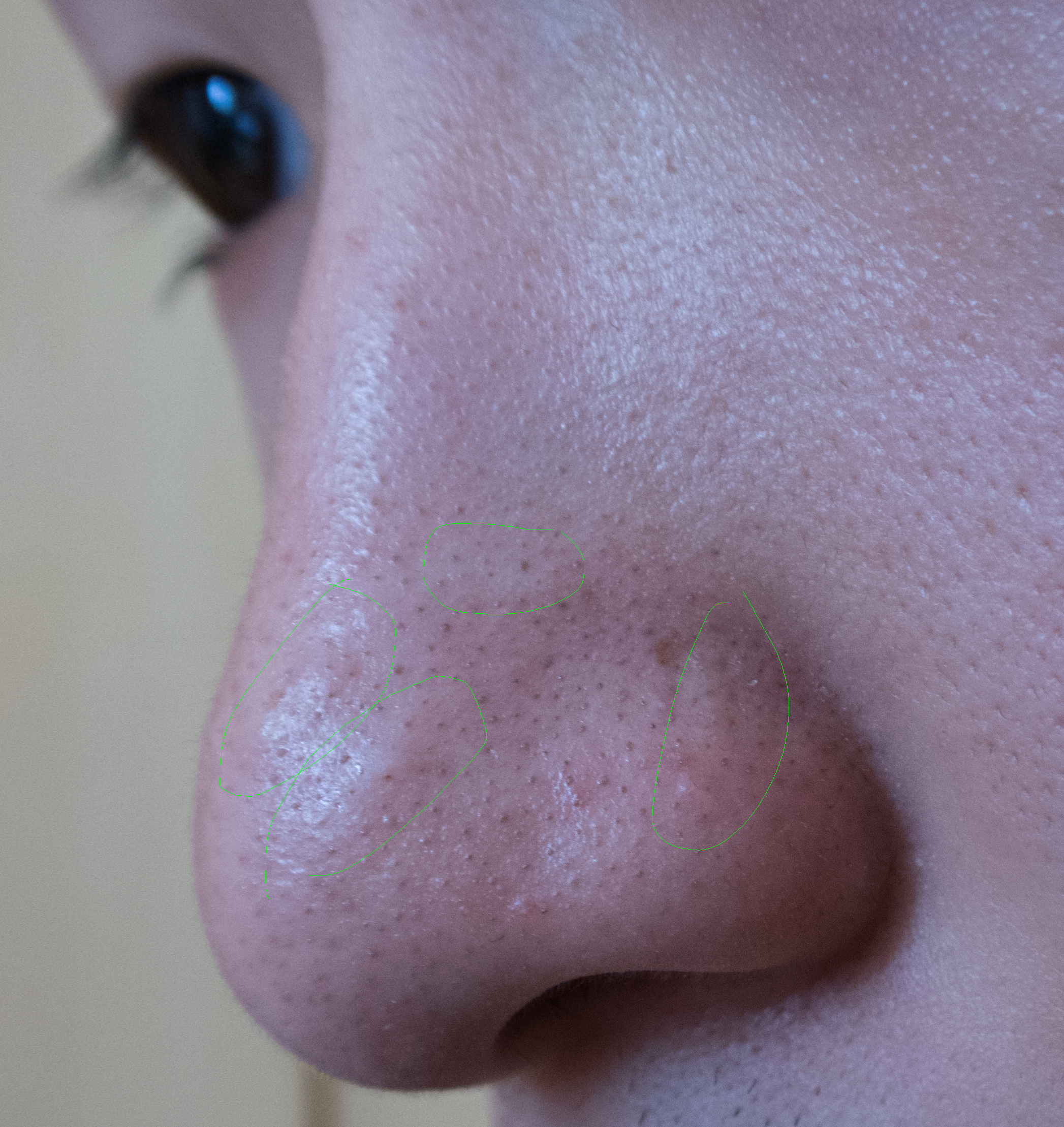 Get Rid Of Bumps On Nose Get Rid Of Bumps