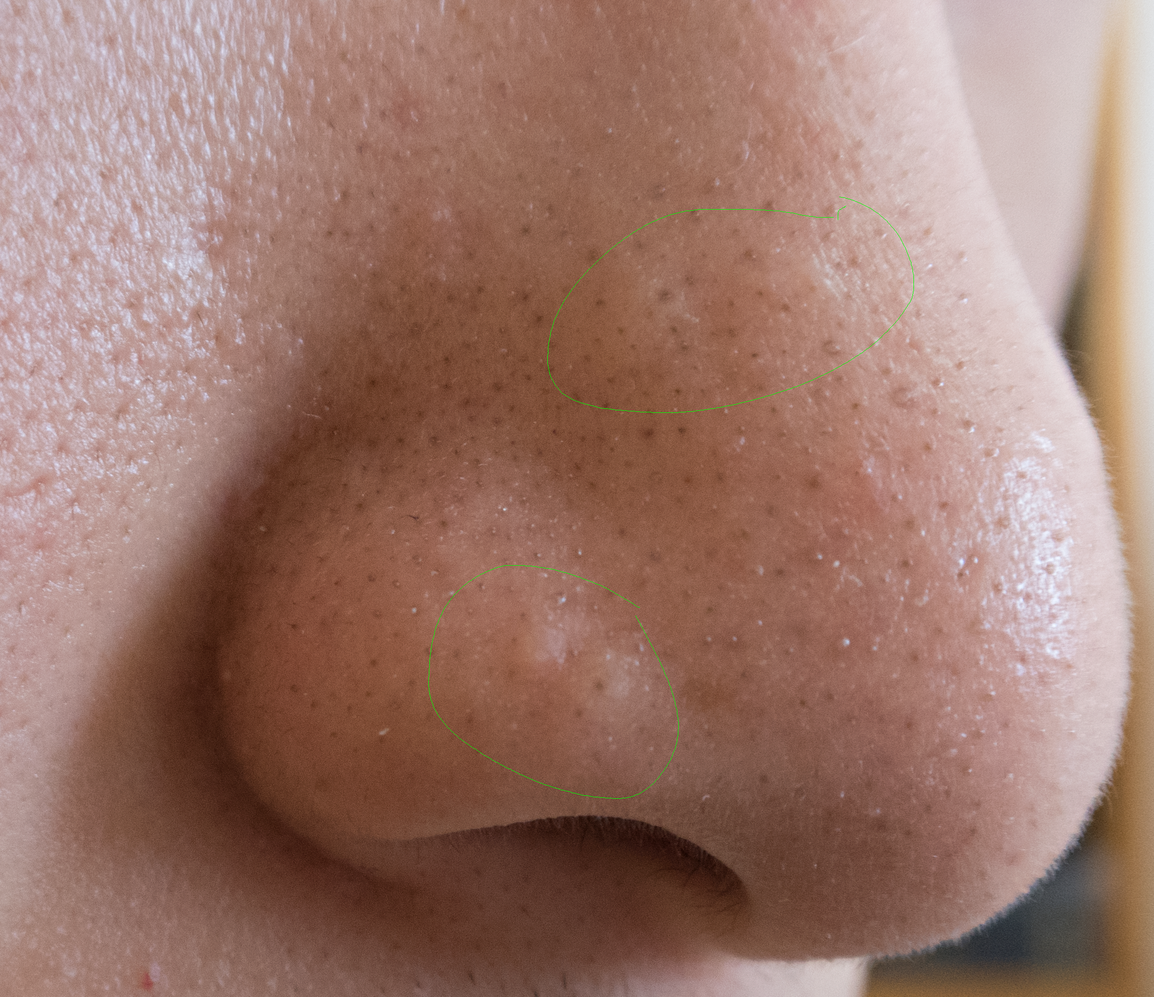 List 102+ Images what are the black spots on my nose Full HD, 2k, 4k