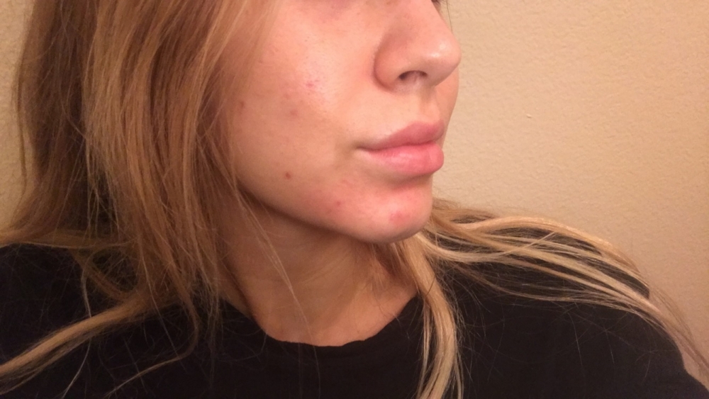 birth-control-and-acne-emotional-and-psychological-effects-of-acne