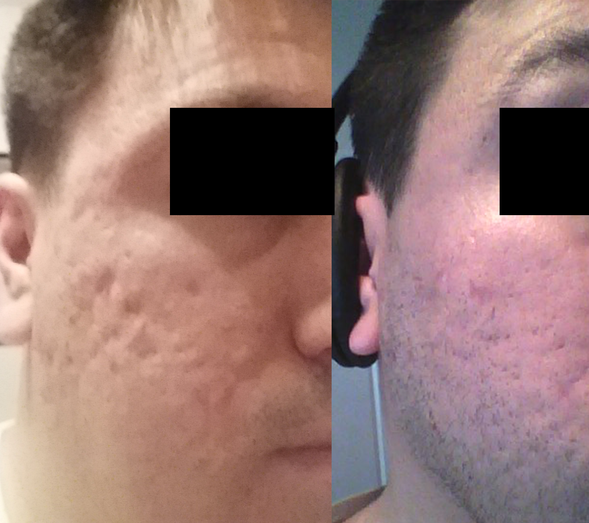 Phenol Acid Peel for bad acne scars 32yr old male Scar Treatments 