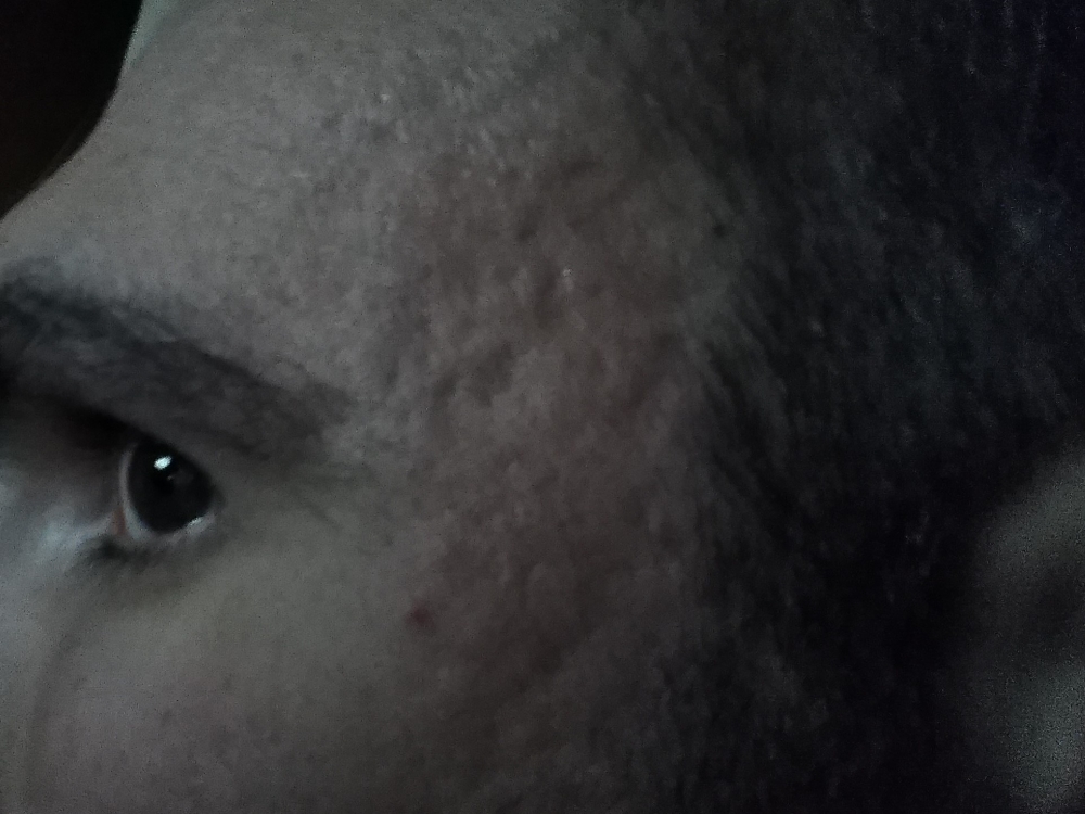 quarta acne.jpg