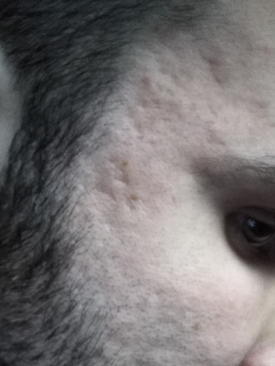 acne 5.jpg