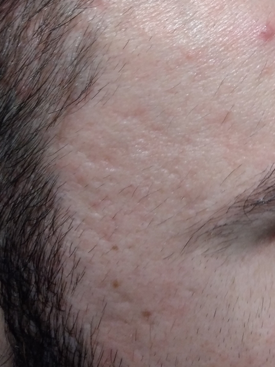 acne 6.jpg