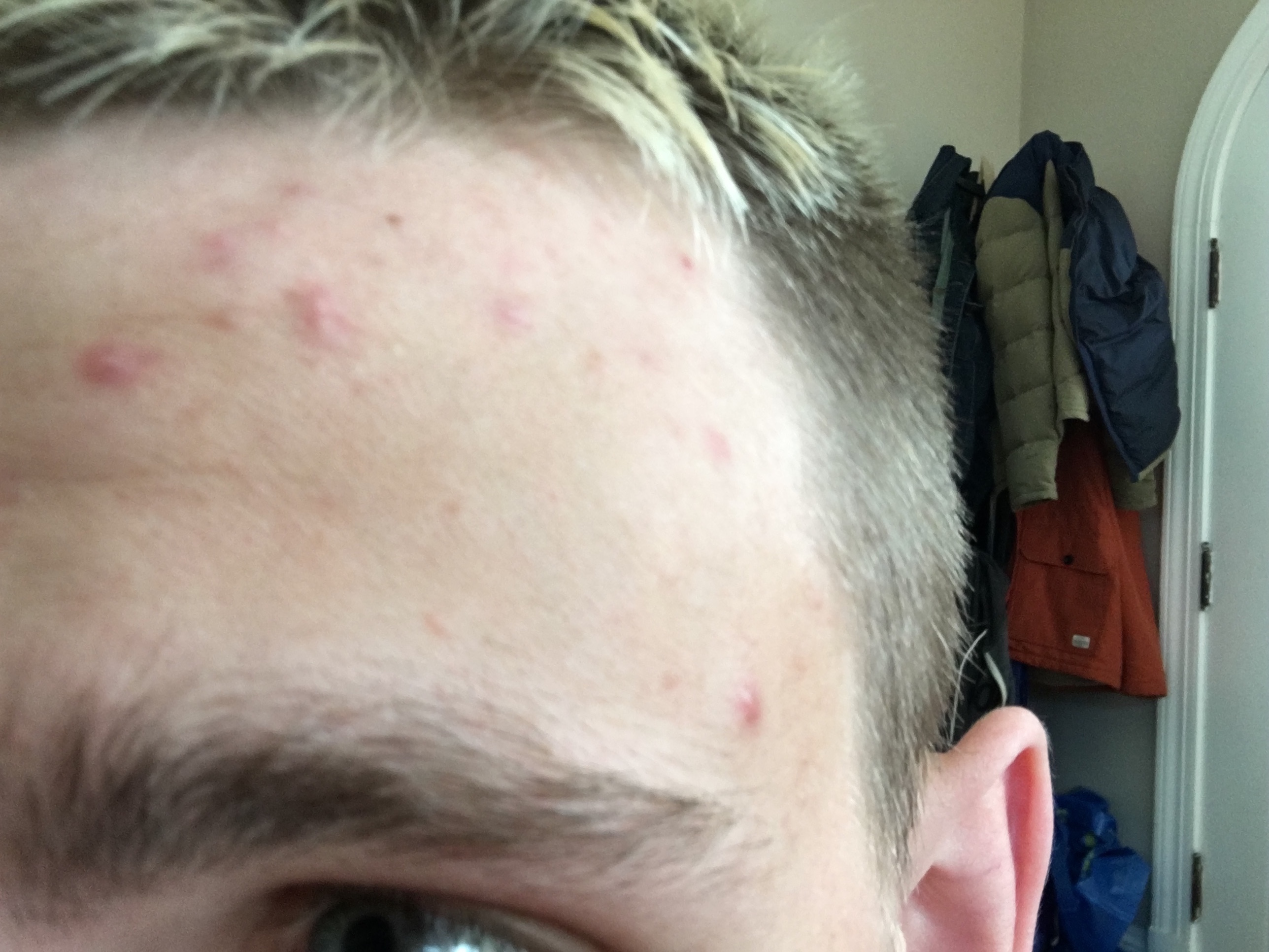 Adult Forehead Acne General Acne Discussion