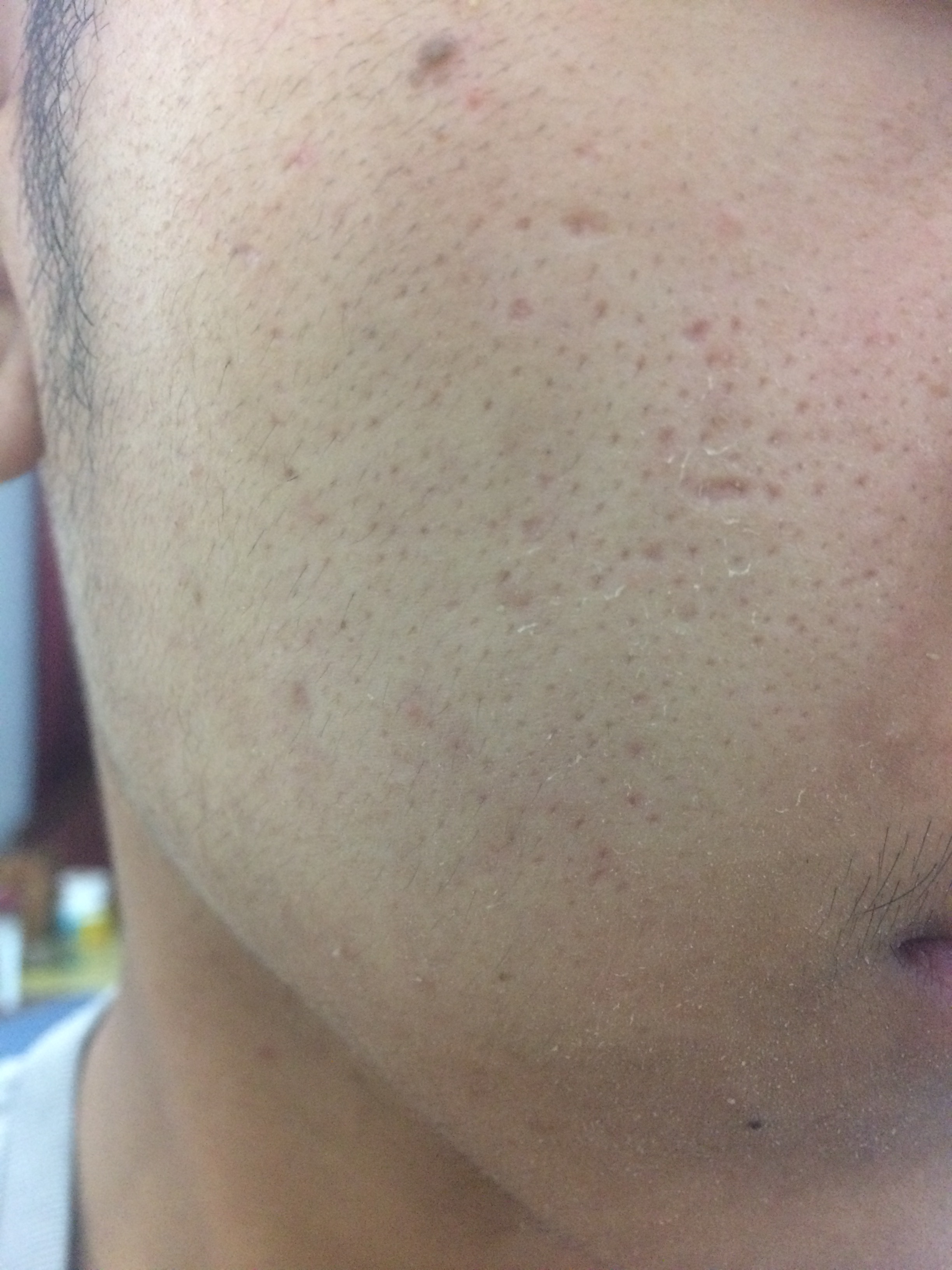 Is this pores or scars?And how to treat it picture include - Scar