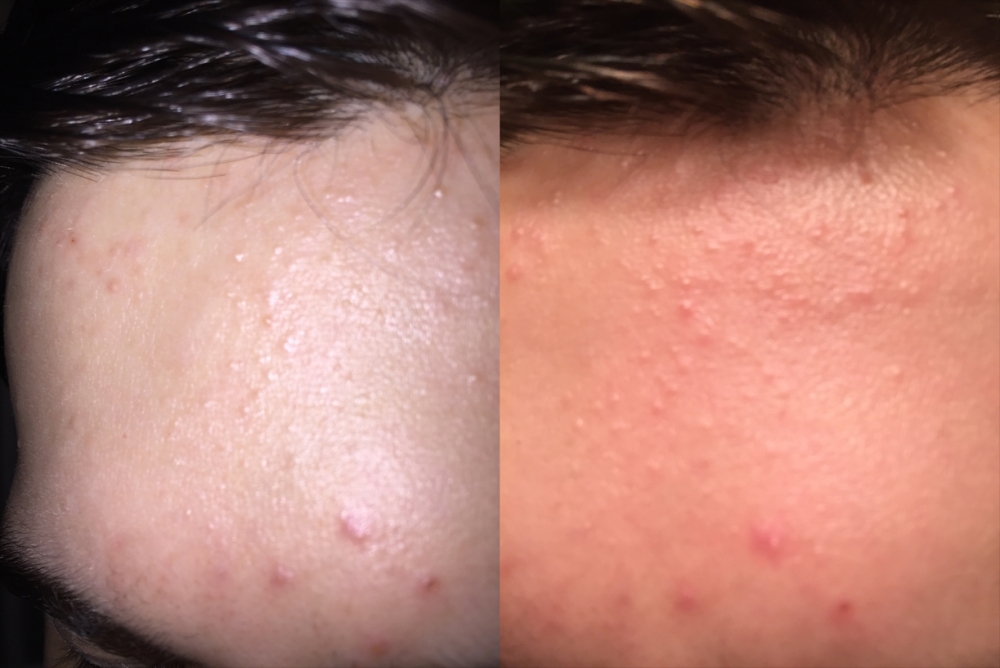 beforetreatment.thumb.jpg.73feea0b746f7977ccb58f17e264744b.jpg