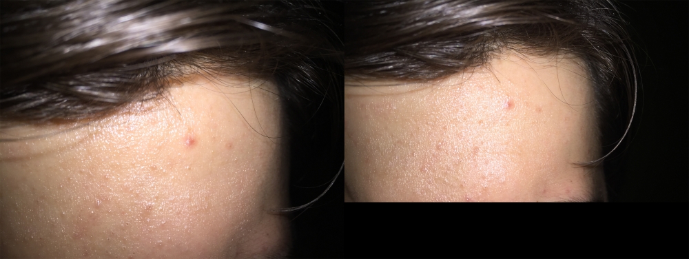 duringtreatment.thumb.jpg.b5a170da3a38082afad8466631aa495a.jpg