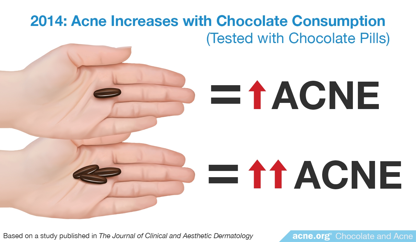 2014 Study: Acne Increases with Chocolate Consumption