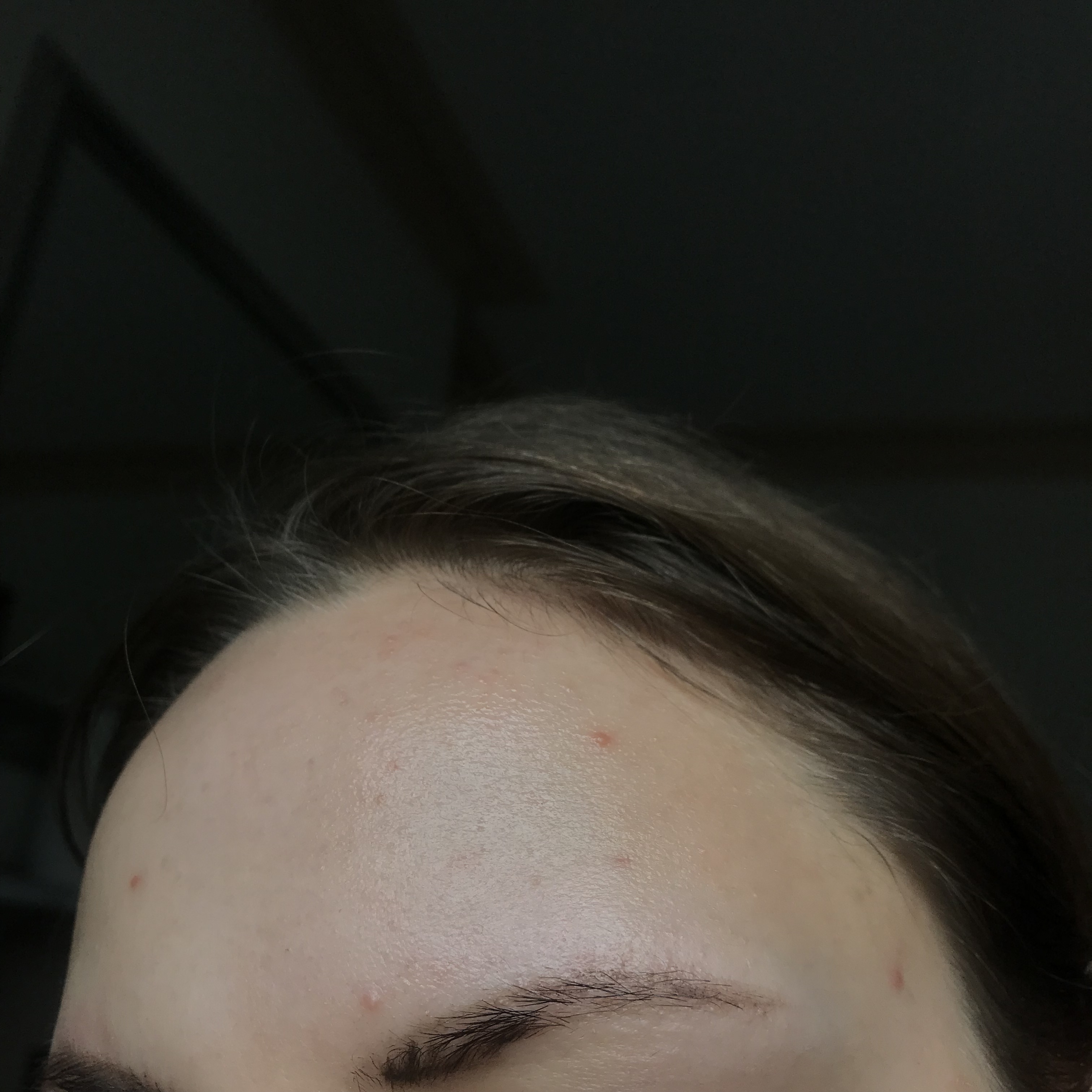 Acne on forehead all the time :( - General acne discussion - Acne.org
