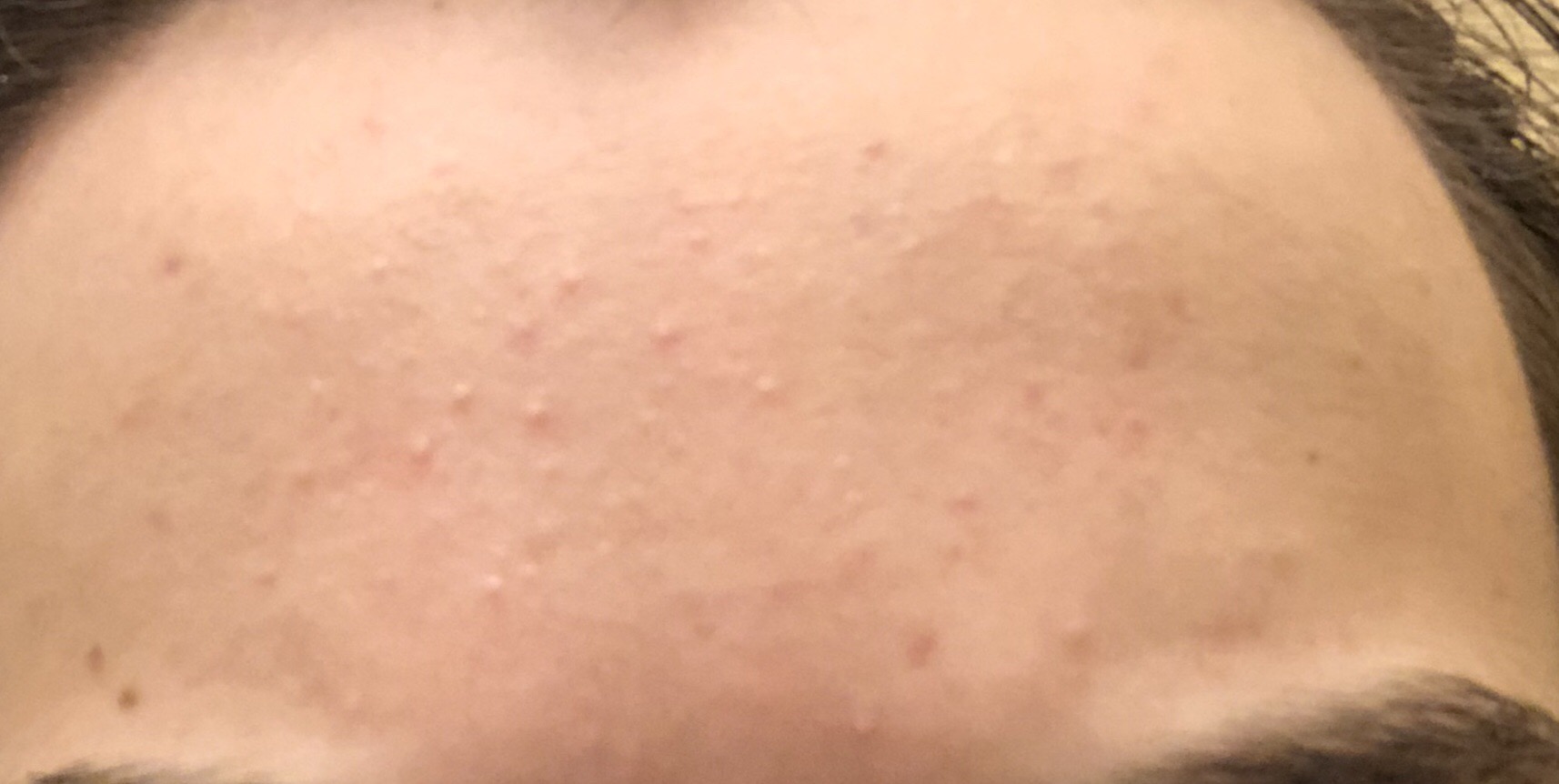 Very Small Forehead Bumps General Acne Discussion
