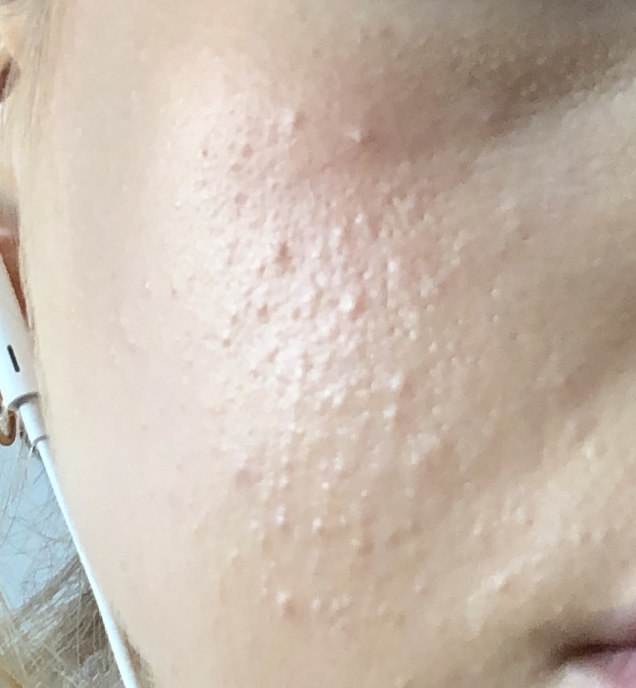 Thousands Of Bumps On My Face General Acne Discussion