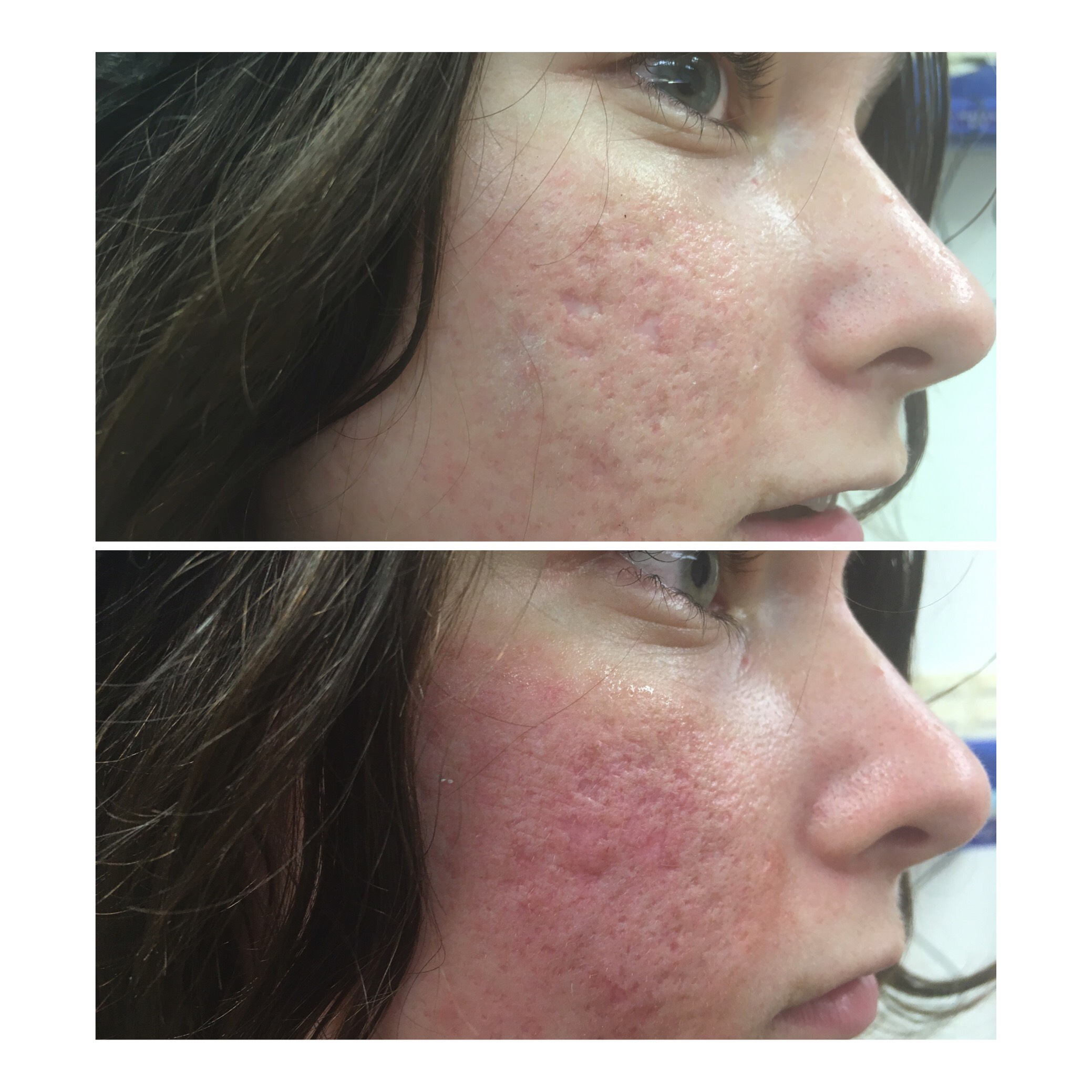 Co2 Laser In Treating Acne Scars Ultrapulse And Subcision Of Acne Scars W Dr Lim Dr Rullan And